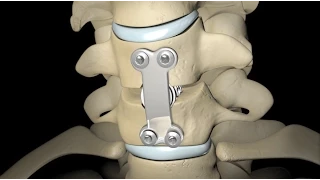 Spinal Fusion (2010)