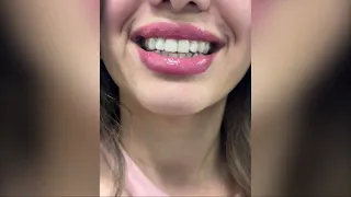 El inicio del camino a la sonrisa perfecta con Invisalign