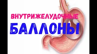 Внутрижелудочные баллоны для снижения массы тела.