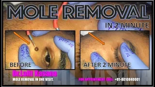 MOLE REMOVAL in 2 minutes by DR.LALIT KASANA
