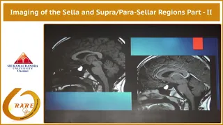 Imaging of the Sella and Supra/Para-Sellar Regions Part - II