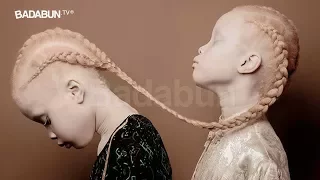 El escalofriante caso de las gemelas albinas. La historia más aterradora del 2017