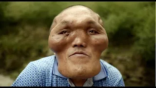 10 Alien like Facial Deformities You Won't Believe Are Real