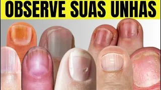 8 Sinais que suas UNHAS Podem Dizer Sobre sua Saúde