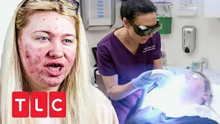 Laser gegen Akne | Dr. Emma: Hautärztin aus Leidenschaft | TLC Deutschland