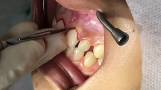 Cirurgia periodontal para tratamento do sorriso gengival