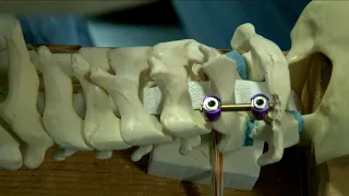 C1-C2 posterior fixation techniques sawbone model demonstration