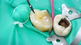 Восстановление зуба пломбой – стоматология Самара