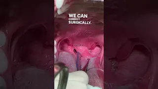 Elongated Soft Palate & Laser Surgery (Staphylectomy)