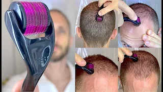 Como Usar o DermaRoller com Minoxidil Aloxidil Tratamento de Calvice Hereditária Queda de Cabelo 4K