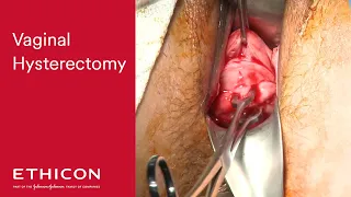 Vaginal Hysterectomy using ENSEAL X1 Large Jaw