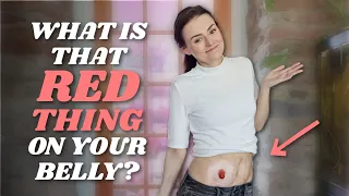 What is a Stoma / Ostomy? (That Red Thing Hanging Out of My Belly!) | Let's Talk IBD