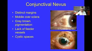 Conjunctival Melanoma (US)