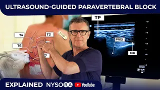 ULTRASOUND-GUIDED PARAVERTEBRAL BLOCK