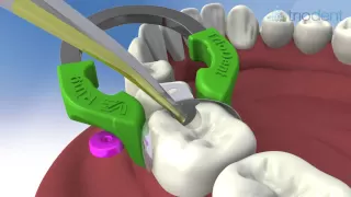 Class II composite restoration using V3 Sectional Matrix System - Triodent