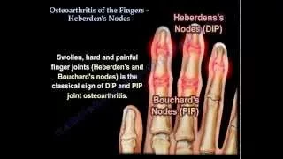 Osteoarthritis Of The Fingers, Heberden's Nodes - Everything You Need To Know - Dr. Nabil Ebraheim