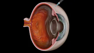 Intravitreal Eye Injection for Macular Degeneration