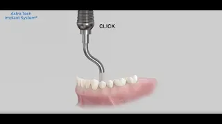 Acuris – conometric concept animation showing the step-by-step single tooth procedure