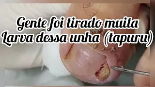 Nunca tinha visto Criar bicho (larvar ou tapuru nas unhas ) #podologia #podologo