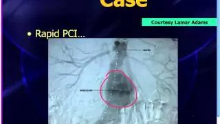 Mattu EKG Vakası - QR-T İşareti ve STEMI - 10 Haz 2013  (Türkçe Altyazılı)