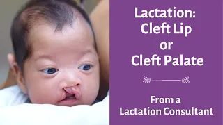 Breastfeeding a baby with Cleft Lip or Cleft Palate