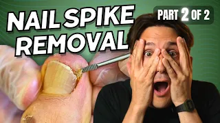 Ingrown Toenail Spike Removal part 2 of 2