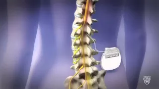 Spine Stimulator for Pain