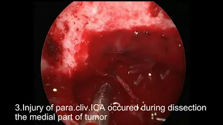 Video1-direct coagulation to seal ICA injury site after proximal and distal control