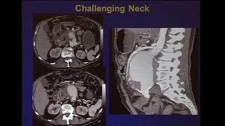 Three-way Debate: Treatment of Short Necks Juxtarenal and Pararenal Aneurysms