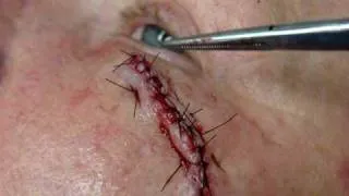 RW Derm - Stitches Near Eye
