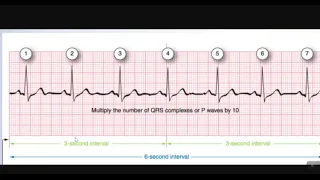 Heart Rate Calculation (6 seconds mothod)