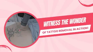 Goodbye Tattoo: Watch The Wonder of Tattoo Removal in Action!