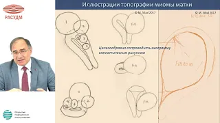 Ультразвуковая диагностика миомы матки