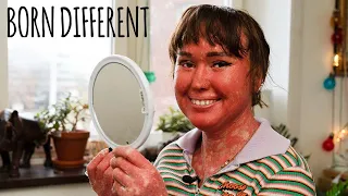 My Skin Grows Too Fast | BORN DIFFERENT