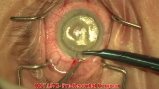 Dr. Brian Foster talks about DSAEK, the latest in corneal transplants.