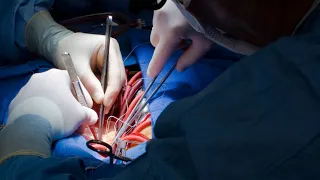 Bicuspidization of the regurgitant unicuspid aortic valve