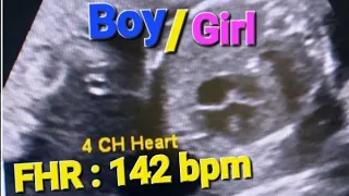 heartbeat ultrasound sound | heart rate boy/girl | Fetal doppler heartbeat sound | fetal heart rate