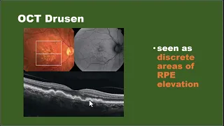 OCT & OCTA in Retinal