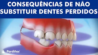 Consequências de não substituir dentes perdidos ©