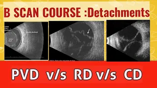 B scan course || differentiate retinal detachment from vitreous detachment and choroidal detachment