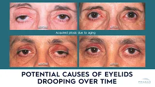 Possible Causes of Drooping Eyelids/ Eyelid Ptosis in Adults