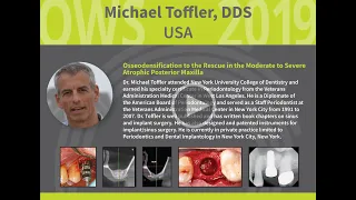 Osseodensification in the Moderate to Severe Atrophic Posterior Maxilla - Michael Toffler