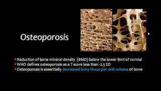 Imaging of Metabolic bone disease I   Prof  Dr  Mamdouh Mahfouz