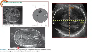 Fetal Evaluation Antepartum Fetal Surveillance