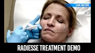 What is RADIESSE™? | Radiesse Demo with Brenda Mintz, NP