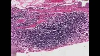 Histopathology Stomach--Chronic gastritis