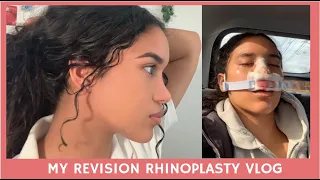 MY REVISION RHINOPLASTY (NOSE JOB) + 3 MONTH NOSE REVEAL