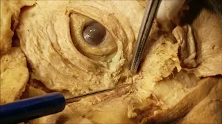 Palpebral and Lacrimal Apparatus Dissection – Clinical Demonstration – Sanjoy Sanyal