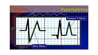 The 12-Lead ECG Course - STE-Mimics Part 4