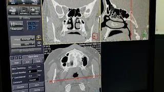 شرح فحص الاشعه المقطعيه علي الجيوب الانفيه علي جهاز توشيبا وكيفية تقطيع الصور /CT PNS from A to Z